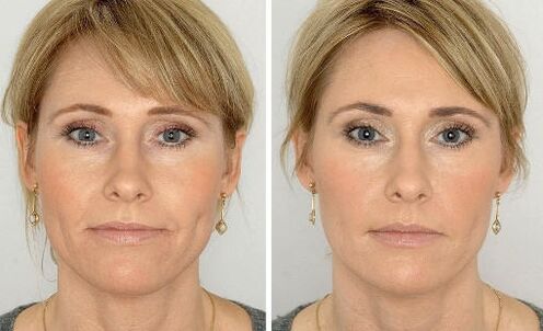 Photos before and after using the cream, experience of using Coralift Valérie de Paris