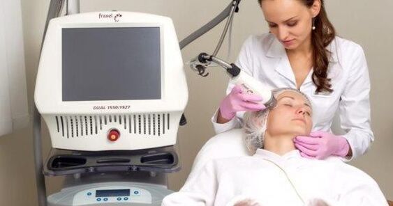 Fractional rejuvenation using a laser
