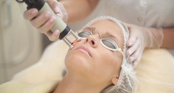Laser rejuvenation