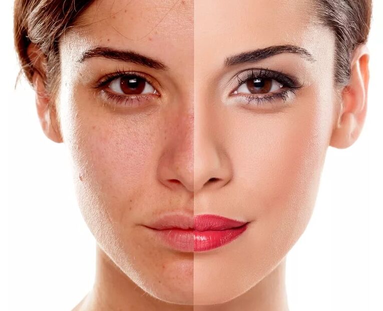 Flat complexion